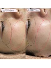 メアリス(Mearis)/毛穴、シミシワ改善