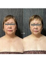 ヒヨリ(hiyori)/《before/after》フェイシャル