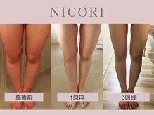 ニコリ 大宮(NICORI)の雰囲気（【下半身プラン】シンデレラ美脚へ＊初回9800円コース）