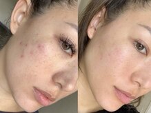 グッドスリープ(Good sleep)/KMP　韓国式ハーブピーリング