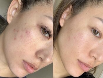 グッドスリープ(Good sleep)/KMP 韓国式ハーブピーリング