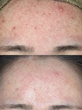 フルール ニコ(Fleur Nico)/1回のBeforeAfter