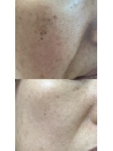 アレイズ(ARAYS)/症例