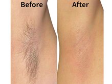 モンロー(MonroE+)/脱毛