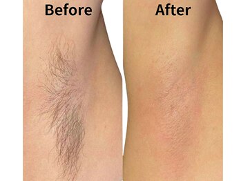 モンロー(MonroE+)/脱毛