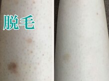 美宝 元町/脱毛は美肌への近道です。