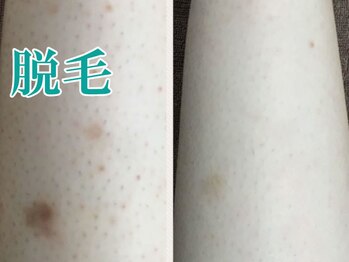 美宝 元町/脱毛は美肌への近道です。