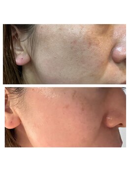 アルバ 広島店(ALBA)/【肌質改善☆】水光ピーリング