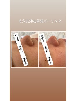 ミント(mint)/#毛穴洗浄#ハーブピーリング