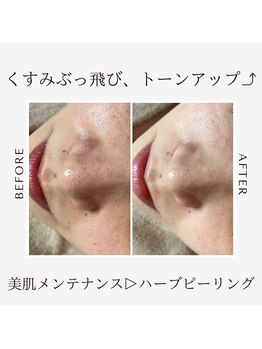 ルシアル(Rucial)/くすみ黒ずみにハーブピーリング