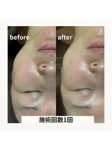 薫風 大阪豊中店/ハーブピーリング