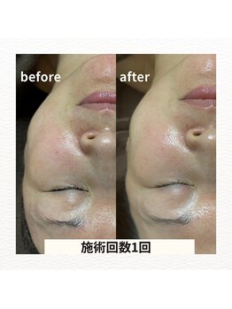 薫風 大阪豊中店/ハーブピーリング