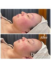 エクセレントビューティーサロン 艶(EN)/ダクトピール　肌質改善