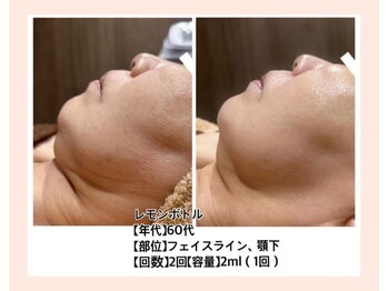 リファイン(REFINE)/レモンボトル原液導入★薄めなし