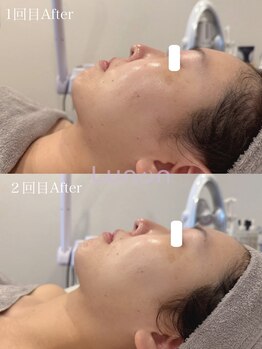 ルノン(Lunon)/ララピール