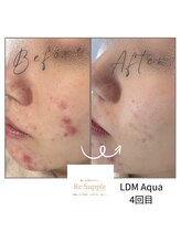 リサプリ(Re: Supple)/ストレス由来の肌荒れニキビケア