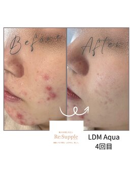 リサプリ(Re: Supple)/ストレス由来の肌荒れニキビケア