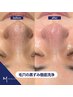 【メンズ毛穴ケア】皮脂が多くなりがちなこれからの季節に毛穴洗浄30分コース