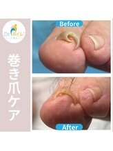ドクターネイル爪革命 群馬両毛店/巻き爪ケア