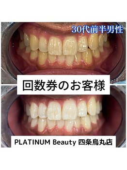 プラチナムビューティ 四条烏丸店(PLATINUM Beauty)/40分照射×6回！ホワイトニング!