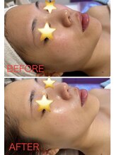 カトレア/★小顔リフトアップ★