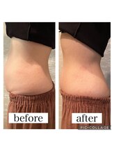 サクラコマチ 川崎駅前店(Sakura komachi)/ハイパーナイフ痩身/おなか　3回