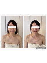 ハートエルボー(Heart elbow)/3回の施術でお顔シャープに