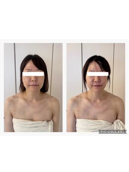 ハートエルボー(Heart elbow)/3回の施術でお顔シャープに