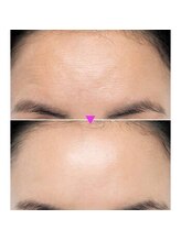 スキンハウス エム(Skin haus M)/セルラムBefore→After