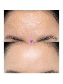 スキンハウス エム(Skin haus M)/セルラムBefore→After