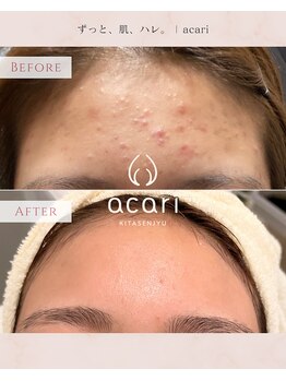 アカリ(acari)/繰り返す額のニキビに
