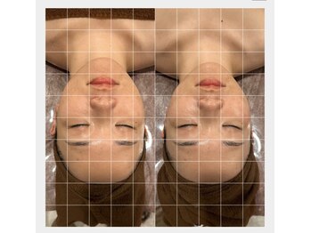 モア(moa)/小顔調整/頭蓋骨矯正/ほうれい線