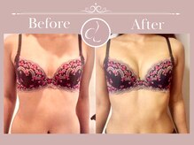 美バストアルファ(美bust α)/【バストアップ】症例