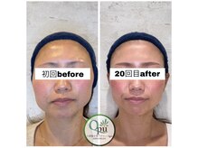 キュープ 相模原淵野辺店(Qpu)/たった4回で人生で1番小さな顔に