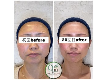 キュープ 相模原淵野辺店(Qpu)/たった4回で人生で1番小さな顔に