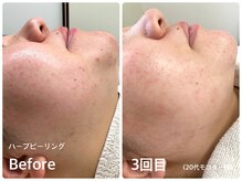 ラウレア(LAULEA)/ハーブピーリング Before/After