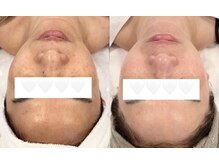 ミミルーチェ(mimiluce)/リアボーテタラソトリートメント