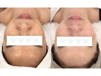 ミミルーチェ(mimiluce)/リアボーテタラソトリートメント