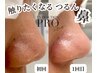 【毛穴が1番気になる方】黒ずみ・角栓・ザラつき解消♪鼻以外に額/頬/顎も