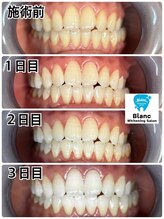 ブラン 心斎橋店(Blanc)/メンテナンス付プラン