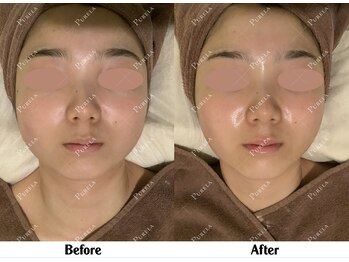 ピュアラ グランピュアラ西梅田店/実際の施術例