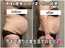 リエル(RIEL)/ラジオ波エステ