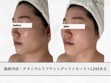 エメ(aimer)/チタニウム《小顔・引き締め》