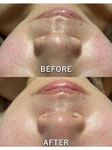 リュミエール(Lumiere)/毛穴レス肌へ