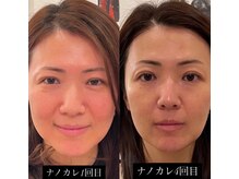 ラウレア(Laule'a)/ナノカレント顔首Before after