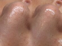 マリーメリー(marie merry)の雰囲気（【毛穴洗浄×フェイスWAX】施術回数：1回毛穴レスな印象へ◎）