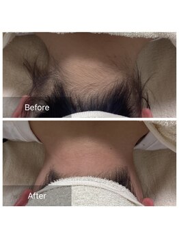 ダリア(Dahlia)/うなじ脱毛