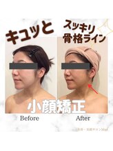 ミエル(Miel)/Before After
