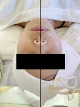 エクリル(Eclire)/小顔/フェイスライン