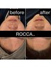 《思春期ニキビ》学割ROCCA..トリートメント♪